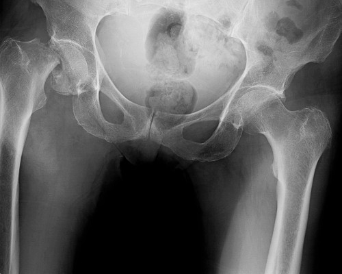 X-ray image of hip