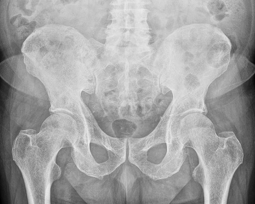 X-ray image of hip