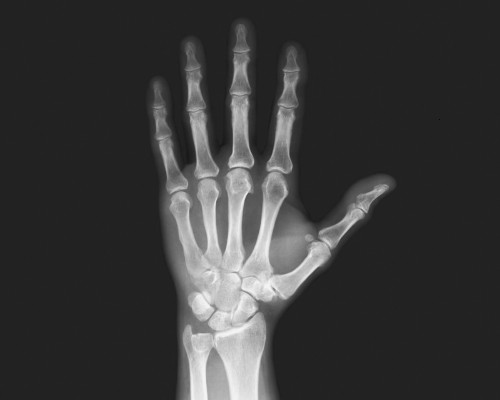 X-ray of left hand