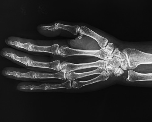 X-ray of human hand