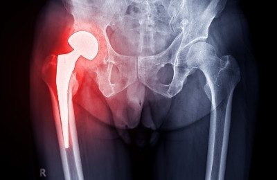 Image of hip highlighting pain area