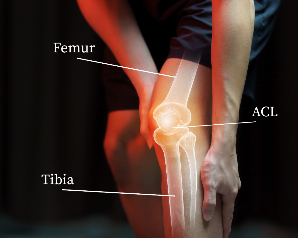Knee photo highlighting the Femur, Tibia and ACL