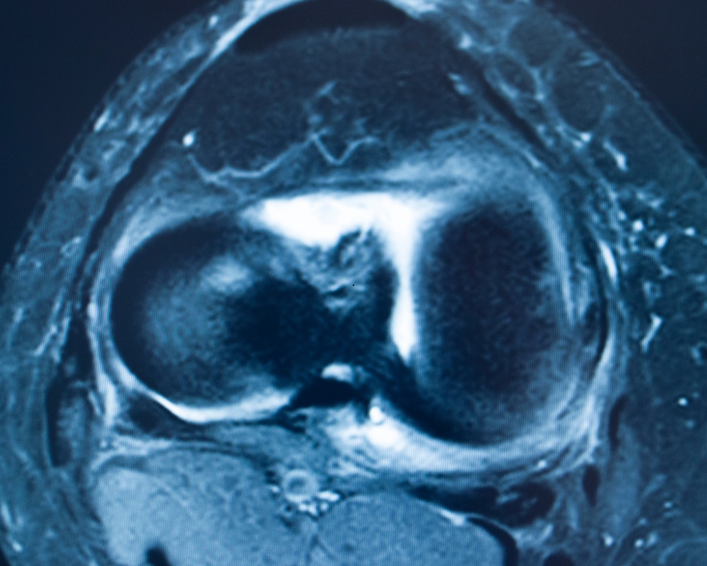MRI Knee ligament tear
