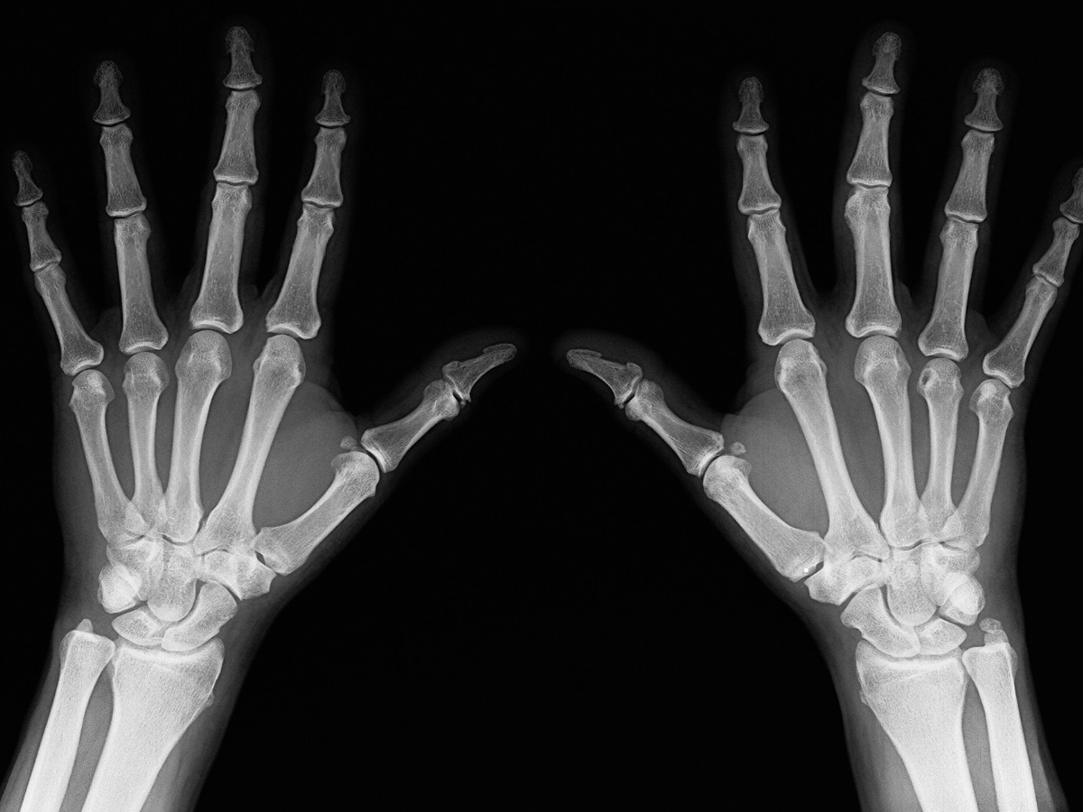 X ray of both hands