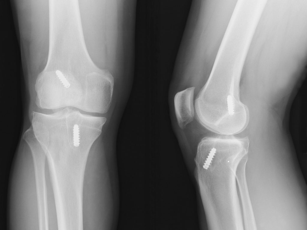 X ray of both knees