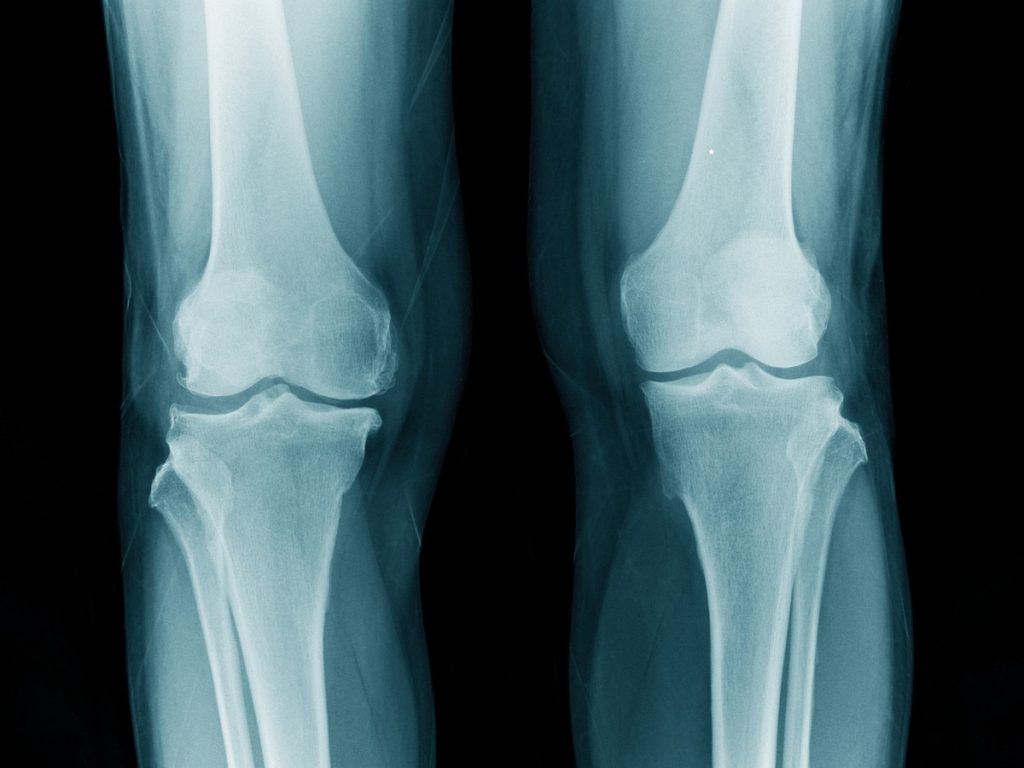 X-ray of knees (1)