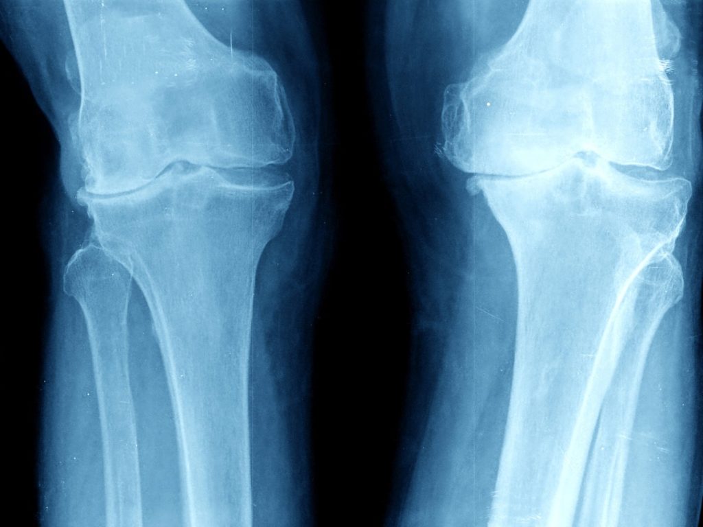 X-ray of knees