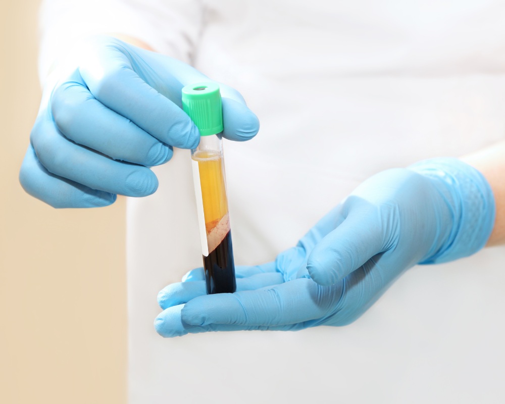 Doctor preparing PRP sample