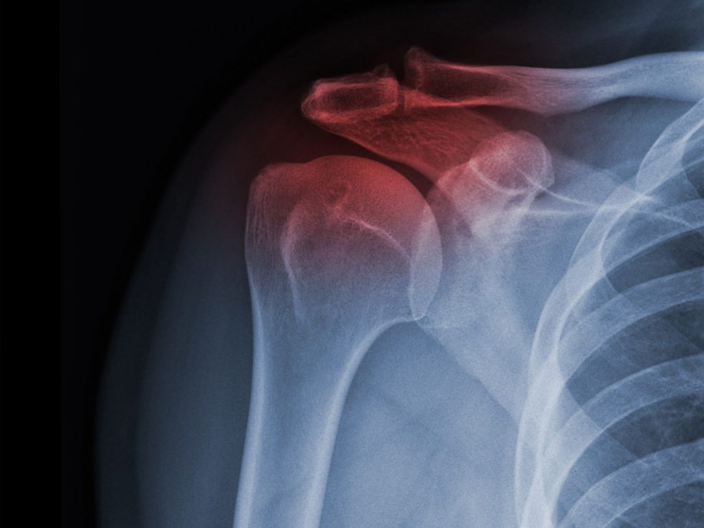 X-ray of injured shoulder (1)