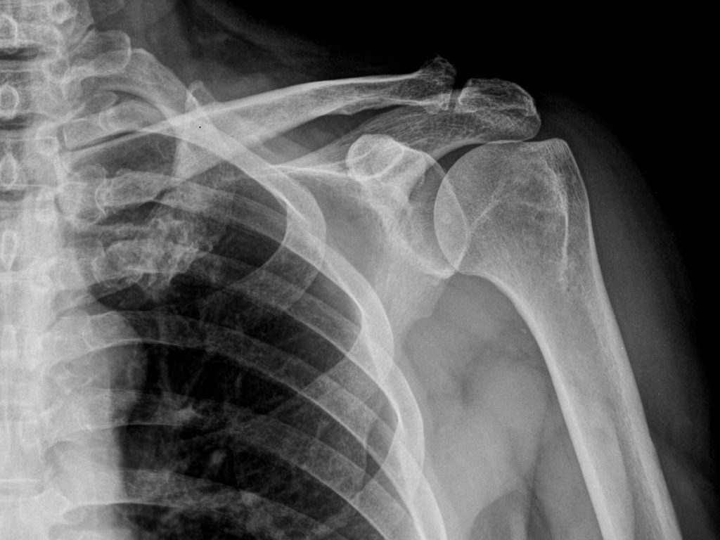 X-ray of left shoulder injury