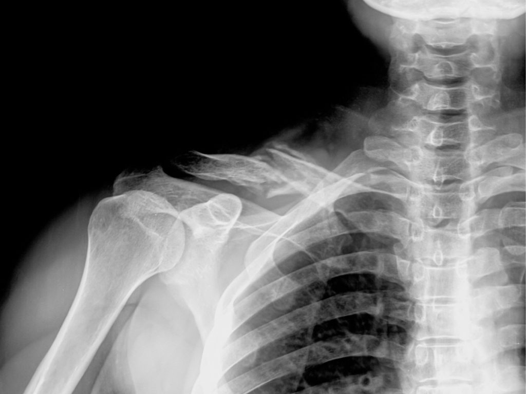 X-ray of the shoulder