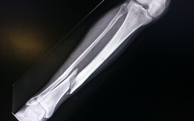 X-ray image of a broken femur